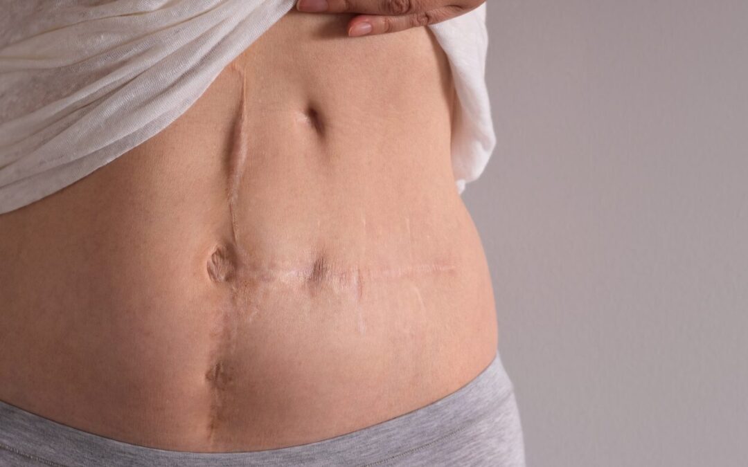 050 Understanding Scar Tissue and How Massage Therapy Can Help